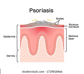 Sección transversal de la piel de psoriasis / ilustración vectorial plana