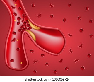 Cross Section Realistic Blood Cells with Plaque Buildup of Cholesterol in Artery Vector Illustration. Health Risk Banner. Landing Page for Clinic, Brochure, Backgrounds for Medical Presentation