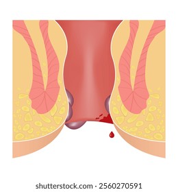 Cross section of the rectum and anal canal. illustration of the structure of hemorrhoids