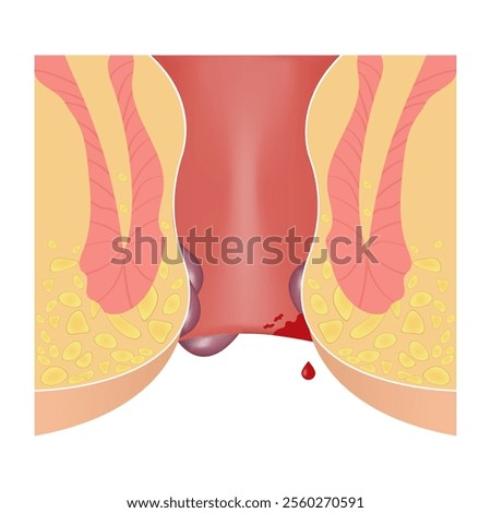 Cross section of the rectum and anal canal. illustration of the structure of hemorrhoids