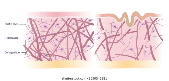 Seção transversal da camada de pele com colagênio intacto e danificado, fibras de elastina e fibroblastos na ilustração do vetor da derme sobre fundo branco. Comparação de pele enrugada jovem saudável e envelhecida.