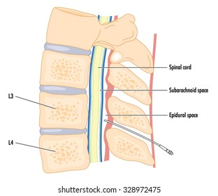 Cross section of the spine showing the spinal cord and the epidural space with a catheter in situ.