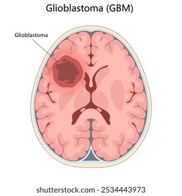 seção transversal do cérebro com um tumor de glioblastoma marcado, destacando sua localização e diagrama de gravidade ilustração vetorial esquemático desenhado à mão. Ilustração educacional de ciências médicas