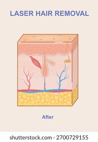Seção transversal da pele humana mostrando o resultado após a remoção de pelos a laser, em um estilo gráfico médico limpo e colorido em um fundo claro. Ilustração vetorial