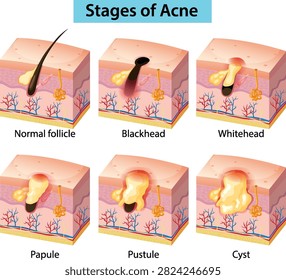 Cross-section vector diagram showing normal follicle, blackhead, whitehead, papule, pustule, and cyst skin conditions.