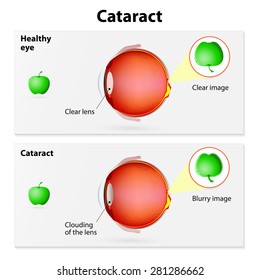 Cross-sectional eye view, showing the cataract