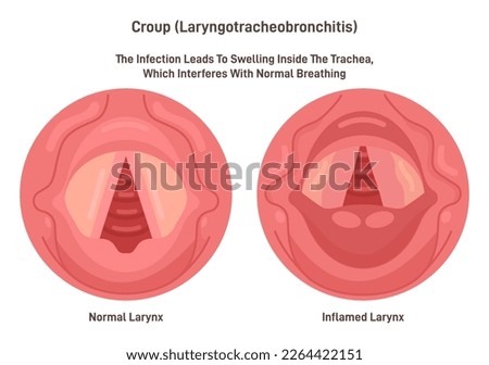 Croup. Upper airway obstruction. Swelling and irritation of vocal cord tube. Breathing-related problem, poor airflow in the lungs. Flat vector illustration