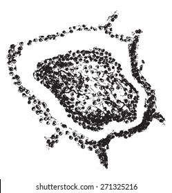 Croupous pneumonia, vintage engraved illustration. 