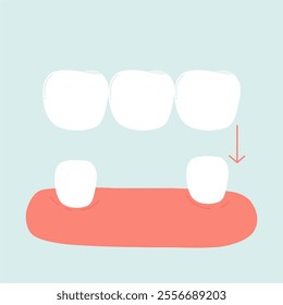 Crown Dentures for Tooth Loss Cases 