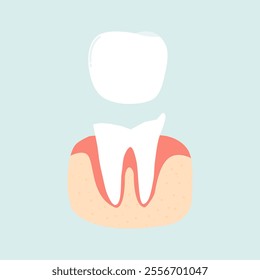 Crown Dentures for Tooth Loss Cases 