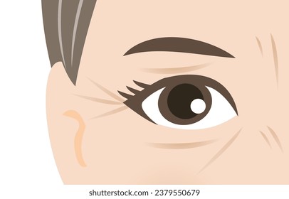 Crown feet and Tear troughs on skin around the eye of mature woman vector illustration. The deep aging eye wrinkles on middle face, periocular or periorbital skin, Frown lines and Bunny lines.
