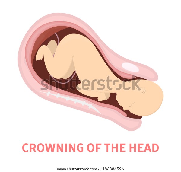 Crowning Head Stage Baby Birth Vaginal Stock Vector (Royalty Free