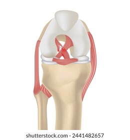 Rotura de ligamento cruzado. Representación realista de la articulación de la rodilla, síndrome del cajón. Cartel médico. Ilustración de vector