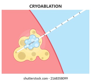 Cryo Ablation And Cold Therapy Treat Cancer