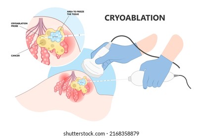 Cryo Ablation And Cold Therapy Treat Cancer