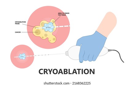 Cryo Ablation And Cold Therapy Treat Cancer