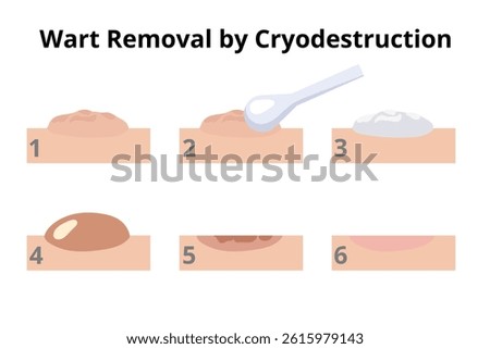 Cryodestruction procedure showing six steps of wart removal process using liquid nitrogen, applied by a dermatologist with a cotton swab applicator, resulting in a blister and final healing