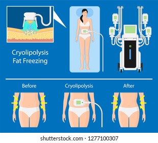 cryolipolysis fat freezing procedure cold treatment non invasive medication reduce temperature break down fat cells removal cosmetic surgery adipose  liposuction Coolsculpting