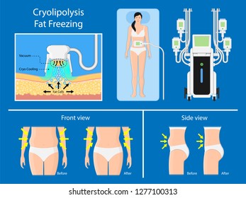 cryolipolysis fat freezing procedure cold treatment non invasive medication reduce temperature break down fat cells removal cosmetic surgery adipose  liposuction Coolsculpting