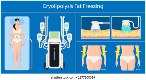 cryolipolysis fat freezing procedure cold treatment non invasive medication reduce temperature break down fat cells removal cosmetic surgery adipose  liposuction Coolsculpting