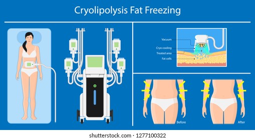 cryolipolysis fat freezing procedure cold treatment non invasive medication reduce temperature break down fat cells removal cosmetic surgery adipose  liposuction Coolsculpting