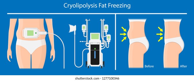 cryolipolysis fat freezing procedure cold treatment non invasive medication reduce temperature break down fat cells removal cosmetic surgery adipose  liposuction Coolsculpting