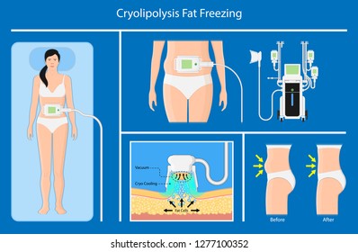 cryolipolysis fat freezing procedure cold treatment non invasive medication reduce temperature break down fat cells removal cosmetic surgery adipose  liposuction Coolsculpting