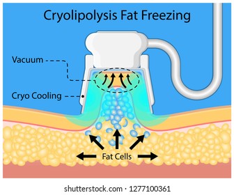 cryolipolysis fat freezing procedure cold treatment non invasive medication reduce temperature break down fat cells removal cosmetic surgery adipose  liposuction Coolsculpting