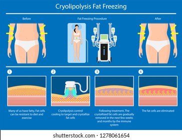 cryolipolysis fat freezing procedure cold treatment non invasive medication reduce temperature break down fat cells removal cosmetic surgery adipose  liposuction Coolsculpting