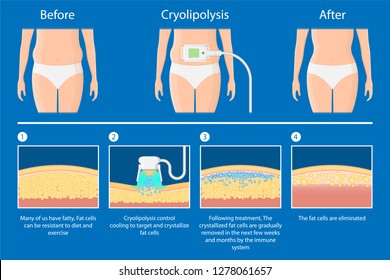 cryolipolysis fat freezing procedure cold treatment non invasive medication reduce temperature break down fat cells removal cosmetic surgery adipose  liposuction Coolsculpting