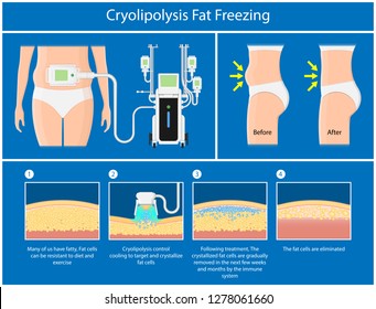 cryolipolysis fat freezing procedure cold treatment non invasive medication reduce temperature break down fat cells removal cosmetic surgery adipose  liposuction Coolsculpting