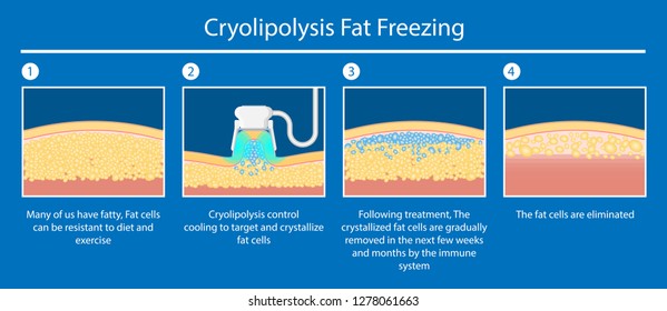 cryolipolysis fat freezing procedure cold treatment non invasive medication reduce temperature break down fat cells removal cosmetic surgery adipose  liposuction Coolsculpting