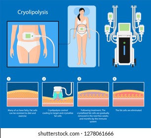 cryolipolysis fat freezing procedure cold treatment non invasive medication reduce temperature break down fat cells removal cosmetic surgery adipose  liposuction Coolsculpting