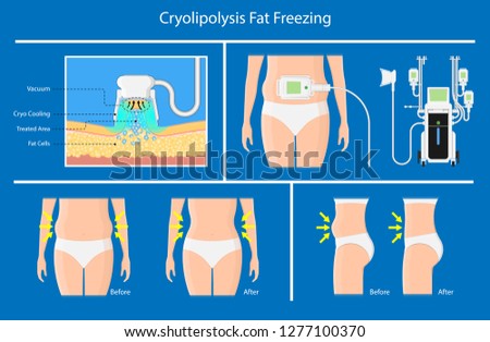 cryolipolysis fat freezing procedure cold treatment non invasive medication reduce temperature break down fat cells removal cosmetic surgery adipose  liposuction Coolsculpting