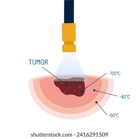 Kryochirurgie Verfahren, Vektorgrafik. Medizinisches Instrument mit kühlendem Flüssigstickstoff für die Tumorbehandlung. Kryogenbehandlung. Entfernen von Maulwurm, Hals, Tumor, Krebs.