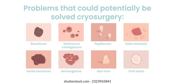 Cryosurgery is used to treat benign and malignant skin tumors. Skin problems that can potentially solve cryosurgery. Flat vector illustration.