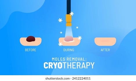 Cryotherapy process vector illustration. Removing mole, wart, tumor, cancer. Different stages of the precision cryoablation. Liquid nitrogen treatment. Targeted frozen surgery for skin health. 