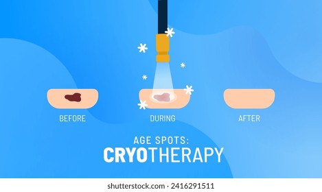 Cryotherapy process vector illustration. Removing age spots on skin. Different stages of the precision cryoablation. Liquid nitrogen treatment. Targeted frozen surgery for skin health and condition. 