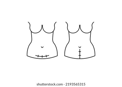 C-section scar on woman's abdomen. Vertical and horizontal. Vector illustration. Minimalism.