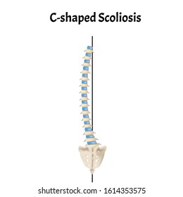 Cshaped Scoliosis Dextroscoliosis Levoscoliosis Spinal Curvature Stock ...