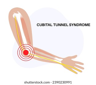 Cubital tunnel syndrome . Pressure or pulling and stretching of the ulnar nerve in the elbow region. Common peripheral neuropathy that affects upper limbs, pain in arms anatomical vector illustration