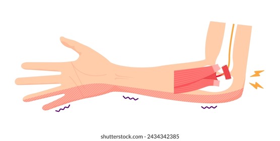 Cubital tunnel syndrome vector illustration