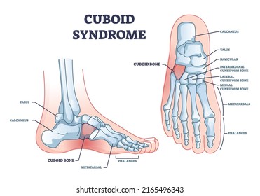 Síndrome cuboide como trauma ortopédico después del diagrama de contorno de lesión torcida en los pies. Esquema educativo etiquetado con dislocación ósea de pies e ilustración vectorial libre de movimiento. Problema de subluxación cuboide.