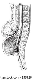 Cup Anteroposterior Spinal Practiced On A Spina Bifida, Vintage Engraved Illustration. Usual Medicine Dictionary By Dr Labarthe - 1885.