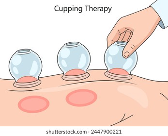 cupping therapy on skin, showcasing suction technique and resulting skin reaction diagram hand drawn schematic vector illustration. Medical science educational illustration