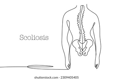 Curvature of the human spine. Scoliosis. One line drawing for different uses. Vector illustration.