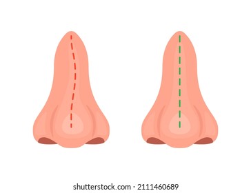 Curve and correct nose, correction nasal curvature, surgery rhinoplasty. Nose before and after treatment. Vector illustration