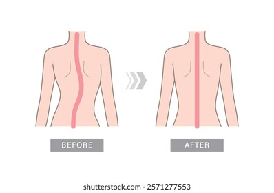 Curved human spine and back. Illustration of scoliosis, normal spine and one with defects