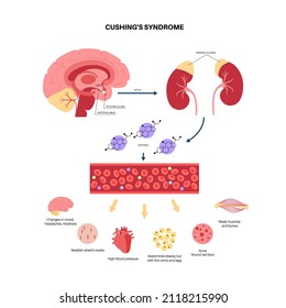 Cushing Syndrome Disease Infographic Poster Cortisol Stock Vector ...