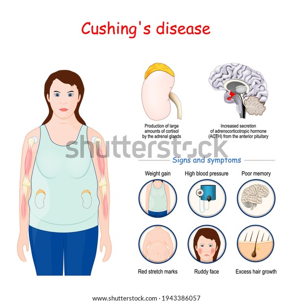 Cushings Disease Signs Symptoms Cushing Syndrome Immagine Vettoriale Stock Royalty Free 